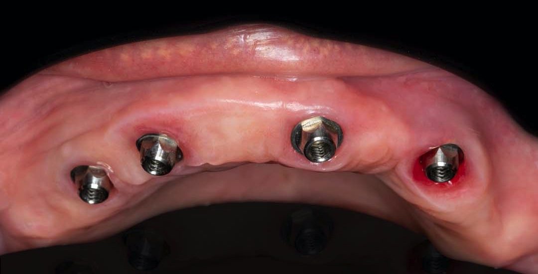 Antes — Prótesis híbrida sobre implantes