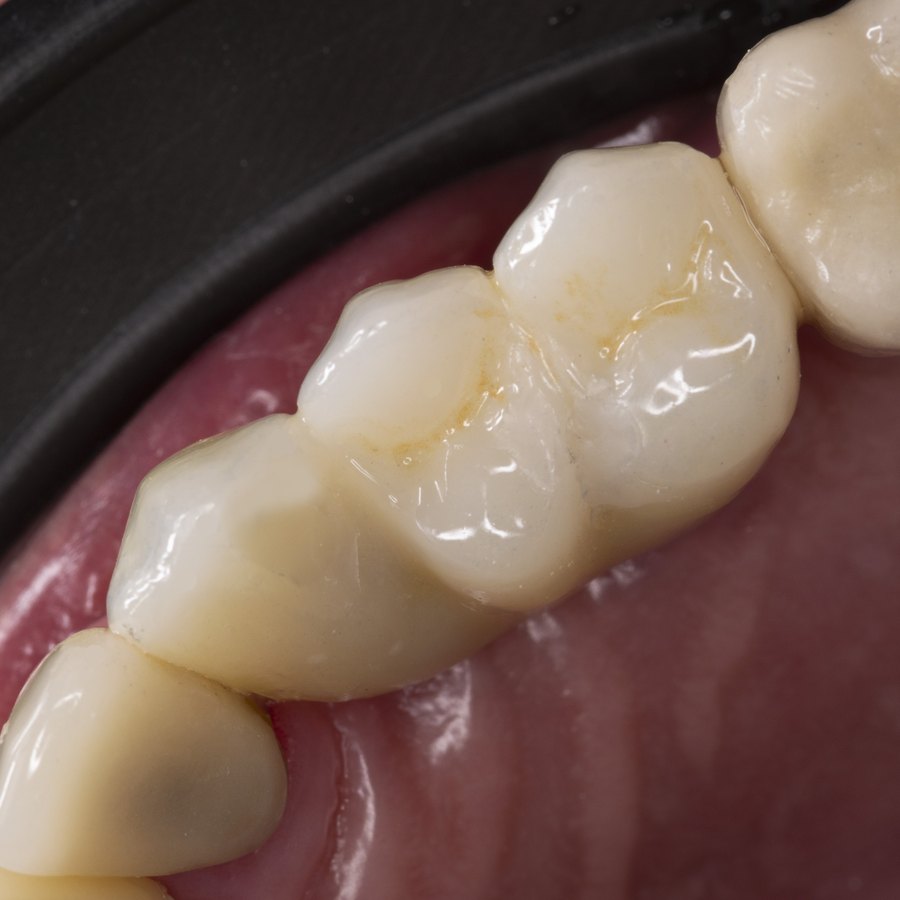 Resultado final — Prótesis fija sobre implantes, caso real de Vela Odontología en Quito