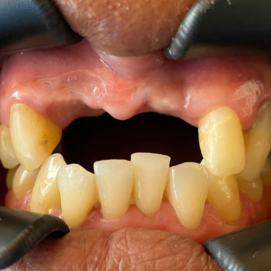 Antes — Rehabilitación sobre implantes
