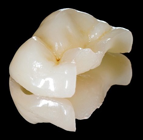 Incrustación (onlay) estética de cerámica, trabajo real de Vela Odontología