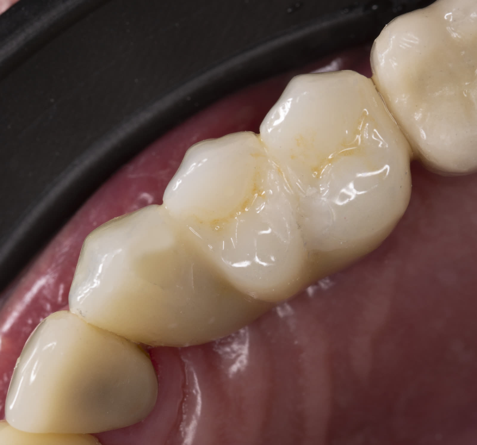 Puente odontológico sobre implantes terminado, caso real de Vela Odontología en Quito