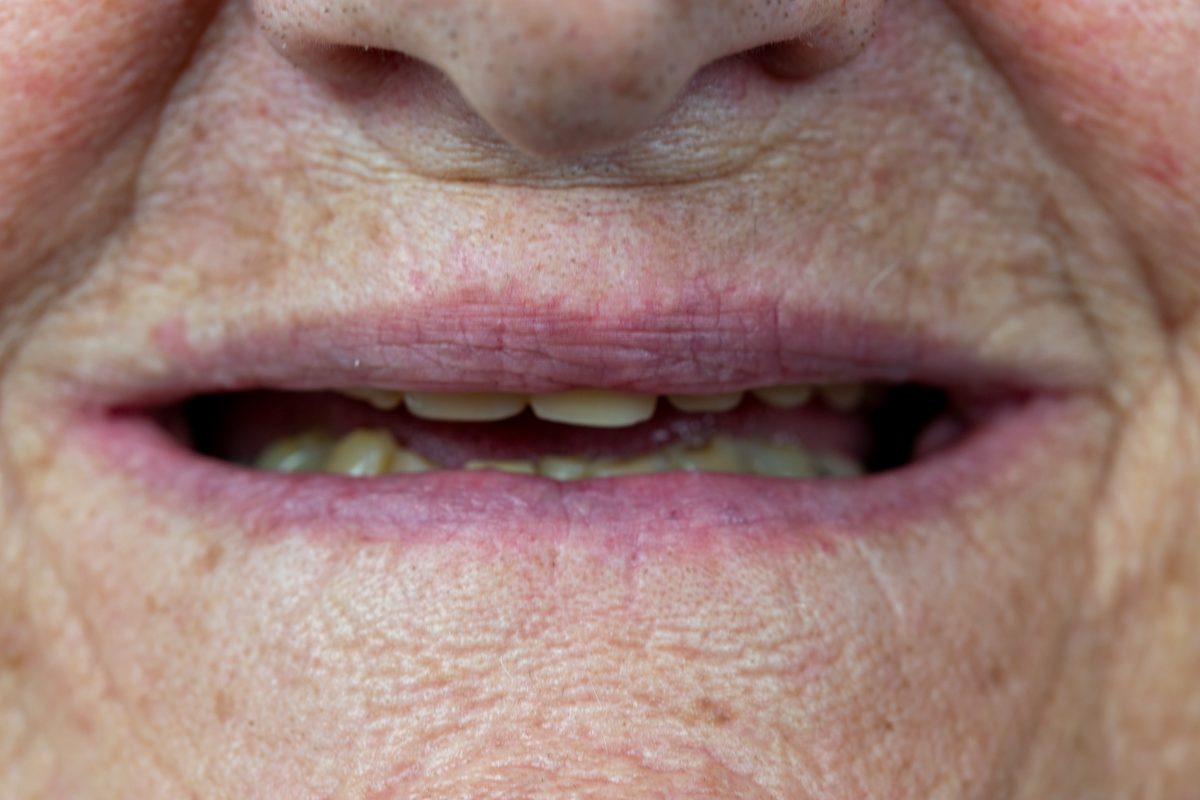 Antes: sonrisa con pocas piezas y desgastadas