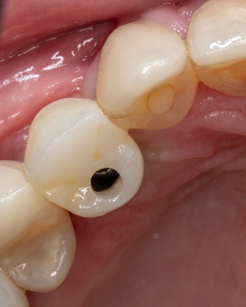 Coronas sobre implantes dentales en boca, caso real de rehabilitación oral en Vela Odontología, Quito